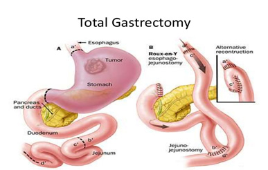 Gastric-Resection-of-Benign-Tumors