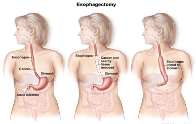 Transhiatal-Esophagectomy