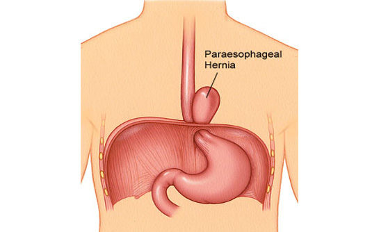 paraesophageal-hernia