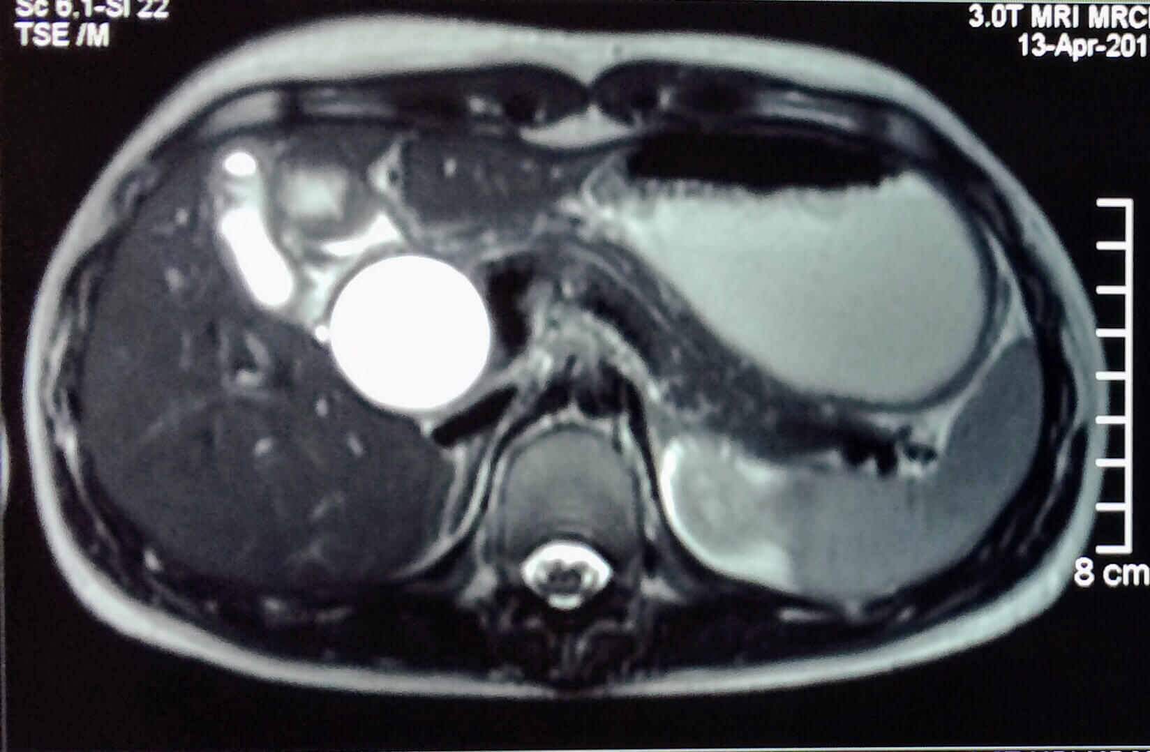 Why the Best Gallbladder Surgeon in Bhopal Matters for Patient Safety